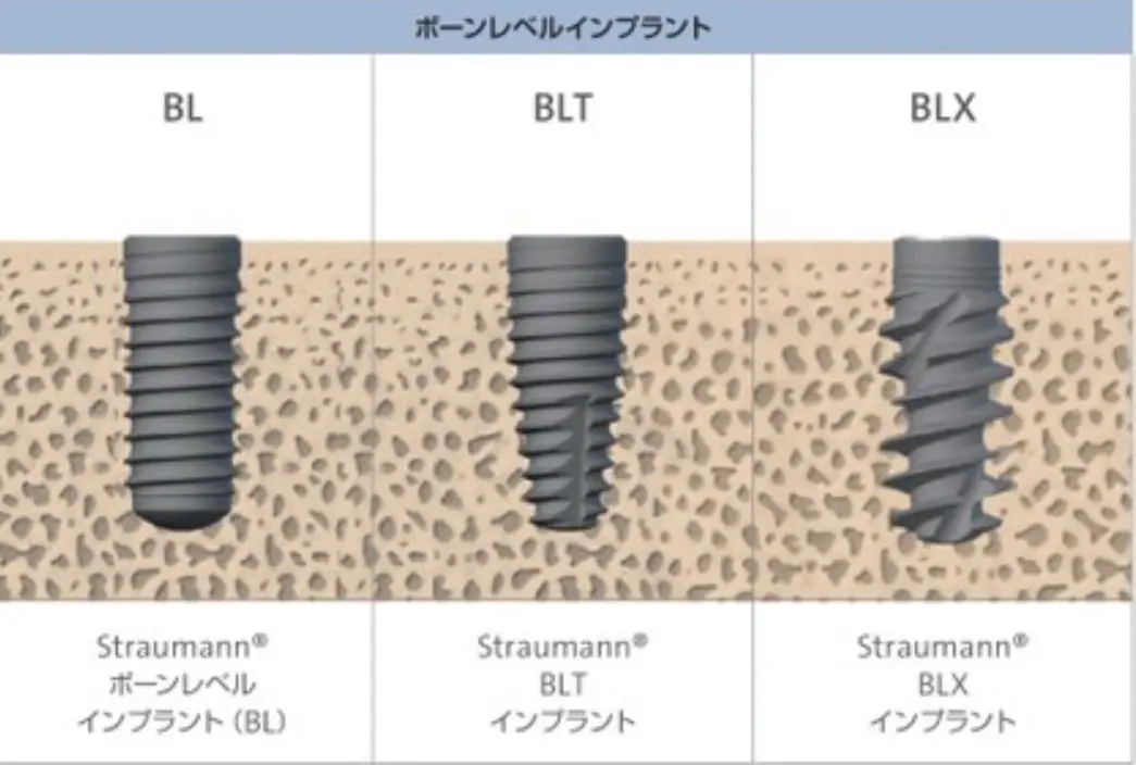 インプラント体とアバットメントの連結