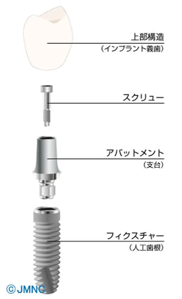 スクリュー固定性インプラント